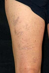 Stage-1-vein-disease