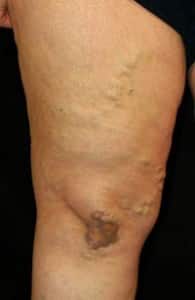 Stage-2-vein-disease