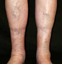 Stage-3-vein-disease