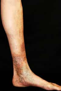 thromboflebits varicoza foot tratament