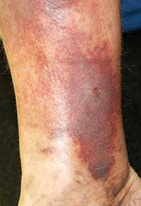 The stages of chronic venous insufficiency - VAI