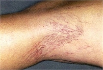 laser-vein-therapy-before-01