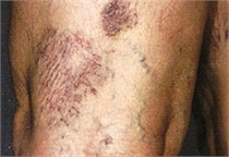laser-vein-therapy-before-02