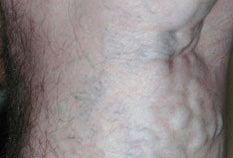 sclerotherapy-before-01