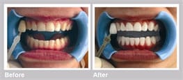 teeth-whitening