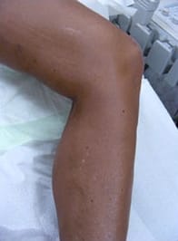 varicose-veins-after-01