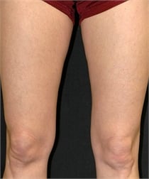 varicose-veins-after-02