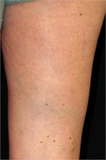 varicose-veins-after-04