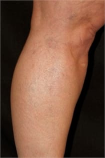 varicose-veins-after-05