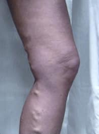 varicose-veins-before-01