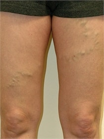 varicose-veins-before-02