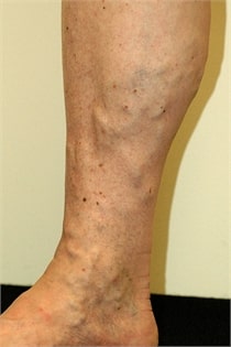 varicose-veins-before-03