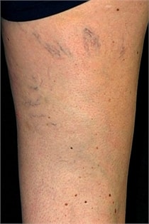 varicose-veins-before-04