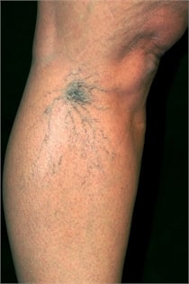 varicose-veins-before-05