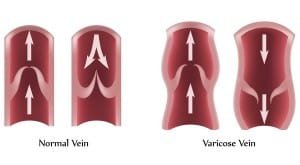 varicose veins