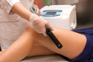 Laser Epilation