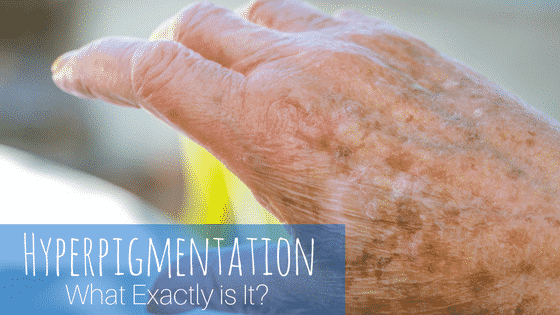 Hyperpigmentation: What Exactly is It?