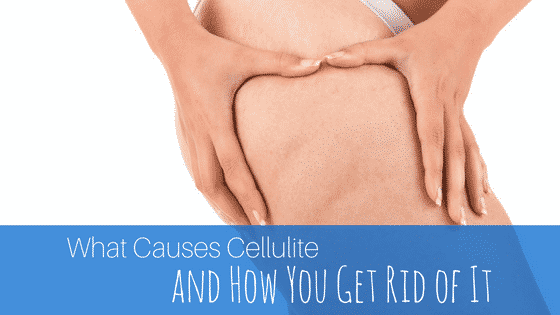 What Causes Cellulite and How To Get Rid of It