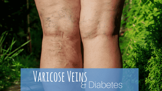 Varicose Veins and Diabetes