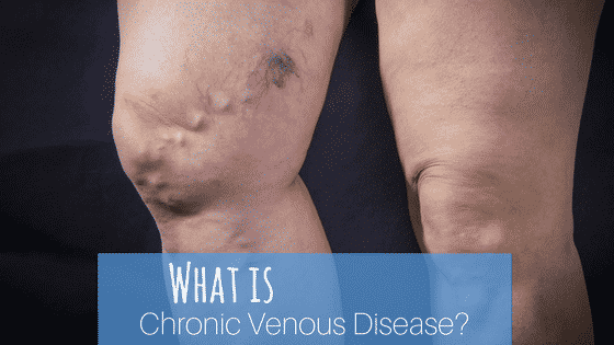 What is Chronic Venous Disease?