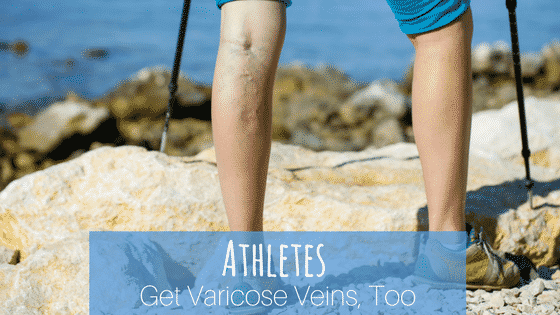 Athletes Get Varicose Veins, Too