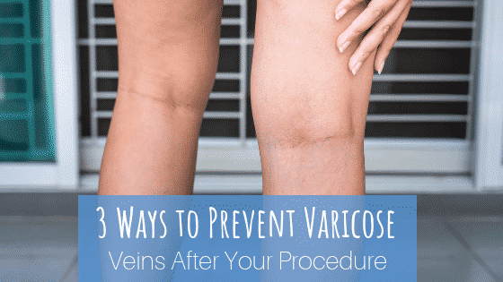 3 Ways to Prevent Varicose Veins After Your Procedure - Summit Skin Care