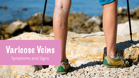 VaricoseVeins