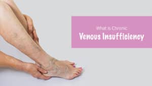 Chronic Venous Insufficiency