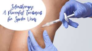 sclerotherapy