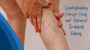 examples of varicose veins